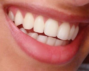 Natural-smile-cambio-seguro-de-amalgamas-diseño-de-sonrisa- (13)