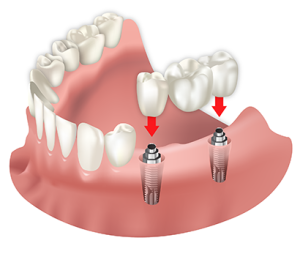 implantes-dentales-natural-smile-
