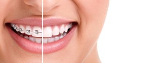 invisalign-vs-ortodoncia-tradicional