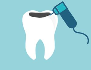 cambio seguro de amalgama